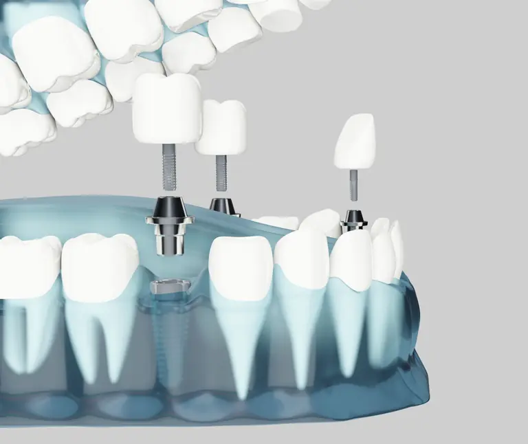 Modelo de implante dental de titanio con su corona